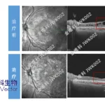 Genevector's JWK002 Gains NMPA IND Approval for XLRS Gene Therapy