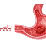 Zai Lab's Bemarituzumab Meets Phase III Endpoint in Gastric Cancer Trial
