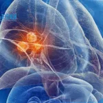 Chengdu Kanghong Receives NMPA Approval for Clinical Trials of KH813 in Metastatic nsq-NSCLC