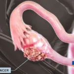 Hisun Pharmaceuticals Receives NMPA Approval for HS387 Clinical Trials in Advanced Solid Tumors