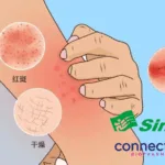 Simcere and Connect Biopharma's Rademikibart NDA Accepted by China's NMPA for Atopic Dermatitis
