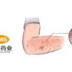 China Medical System's CMS-D001 Gains NMPA Approval for Atopic Dermatitis Trials