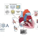 Peijia Medical Completes First Patient Implantation for MonarQ TTVR System in Global Clinical Study