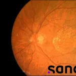 Sanofi's Gene Therapy SAR446597 Secures FDA Fast Track for Geographic Atrophy