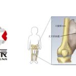 Konruns' KC1036 Proposed for CDE's SPARK Program to Accelerate Pediatric Ewing’s Sarcoma Treatment Development