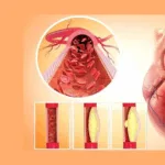 Zhongke Yian Receives NMPA Approval for Innovative Sirolimus-Eluting Coronary Stent