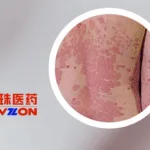 Joincare's LZM012 Meets Phase III Endpoint for Psoriasis Treatment