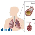 Genentech's Astegolimab Shows Promising Results in Phase IIb COPD Trial