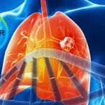 Bayer's Sevabertinib Granted Priority Review by China's NMPA for NSCLC Treatment