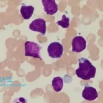 HRAIN Biotech's HICARA Approved by NMPA for Relapsed/Refractory LBCL