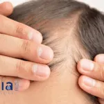 Cutia Therapeutics' CU-40102 Approved in Hong Kong for Androgenetic Alopecia Treatment