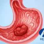 Hengrui's Trastuzumab Rezetecan Granted FDA Orphan Drug Designation for Gastric Cancer Treatment