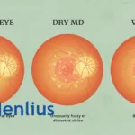 Henlius Biotech's HLX04-O Accepted by NMPA for Wet AMD Treatment