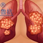 Shandong Lukang's CIGB-814 Starts Phase 1 Trial for Rheumatoid Arthritis Treatment