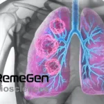 RemeGen's RC148 Granted Breakthrough Therapy Designation for NSCLC Treatment