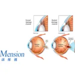 Ocumension's OT-301 Meets Primary Endpoint in Denali Phase III Trial
