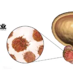 Yantai Dongcheng's 225Ac-LNC1011 Injection Gains FDA Approval for Prostate Cancer Trial
