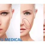 Lepu Medical Secures NMPA Approval for Innovative Sodium Hyaluronate Dermal Filler