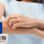 Shenlian Bio Launches Phase 2 Trial for UB‑221 Injection in Chronic Urticaria