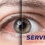 Servier Secures Global Rights to Darovasertib for Uveal Melanoma Treatment