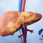 Hengrui’s HRS‑4729 GLP‑1 Triple Agonist Receives NMPA Approval for MASLD & MASH