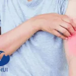 Hengrui’s RSS0393 PDE4 Inhibitor Approved for Atopic Dermatitis Clinical Trial