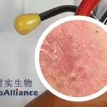 Junshi Biosciences' JS005 IL‑17A Antibody Shows Promise in Phase III Psoriasis Trial