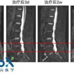 FibroX Therapeutics Secures IND Approval for FibroCell in Lumbar Disc Degeneration