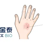Genrix Succeeds with Telikibart Phase 3, Targets Atopic Dermatitis