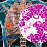 Sichuan Kelun‑Biotech’s A400 Receives NDA Acceptance in China