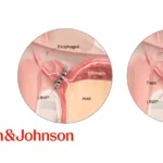 Johnson & Johnson Announces International Withdrawal of Linx Reflux System