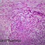 Sichuan Biokin Secures Second Breakthrough Therapy Designation for Izalontamab Brengitecan in Advanced Urothelial Carcinoma