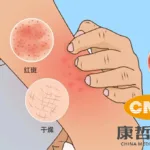 CMS Announces Phase 3 Success of Ruxolitinib Cream in Atopic Dermatitis