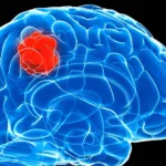 Northeast Pharma Secures NMPA Approval for DCTY0801 Injection Targeting EGFRvIII‑Positive Brain Gliomas