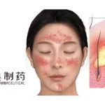 Jiudian Pharma Acquires Chengdu Peide’s JIJ02 Gel, Advancing a Novel Acne Treatment into Phase 1