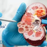 Novo Nordisk Secures Global Rights to Zaltenibart in Deal with Omeros