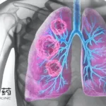 Huadong’s Mefatinib Approved by NMPA for EGFR‑Driven NSCLC