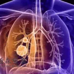 Hansoh Pharmaceutical Submits HS‑10365 NDA to NMPA for RET‑Positive NSCLC