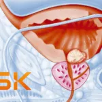 GSK Secures Global Rights to Syndivia’s ADC for Metastatic Prostate Cancer