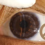 GenAns Biotechnology Receives FDA Fast‑Track Designation for GA001 Injection, a Promising Gene‑Therapy for Retinitis Pigmentosa