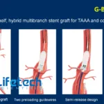 LifeTech Scientific Secures NMPA Approval for G‑Branch TAAA Stent‑Graft System