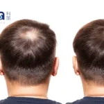Cutia's CU-40105 Topical Finasteride Spray NDA Accepted by NMPA, a China First