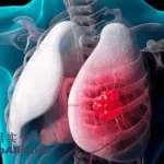 Junshi's JS001sc Subcutaneous PD-1 Meets Phase 3 Endpoint in NSCLC
