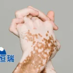 Hengrui's Ivarmacitinib Wins NMPA Nod for Vitiligo Clinical Trials