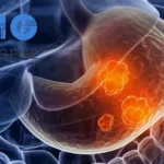 Antengene ATG-022 CLDN18.2 ADC Gets China Nod for Keytruda Combo in Gastric Cancer