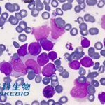 Anke-Biotech PA3-17 CAR-T Pediatric Indication NMPA Accepted