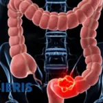 Asieris APL-1401 Ulcerative-Colitis Phase 1b Data Positive