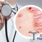 Junshi Biosciences roconkibart psoriasis NMPA Acceptance