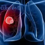 Abbisko ABSK043 NSCLC Combo Shows 71% Disease Control at ESMO Asia