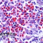 Huadao Submits China CAR‑T Application for Refractory Lymphoma in $1B Market